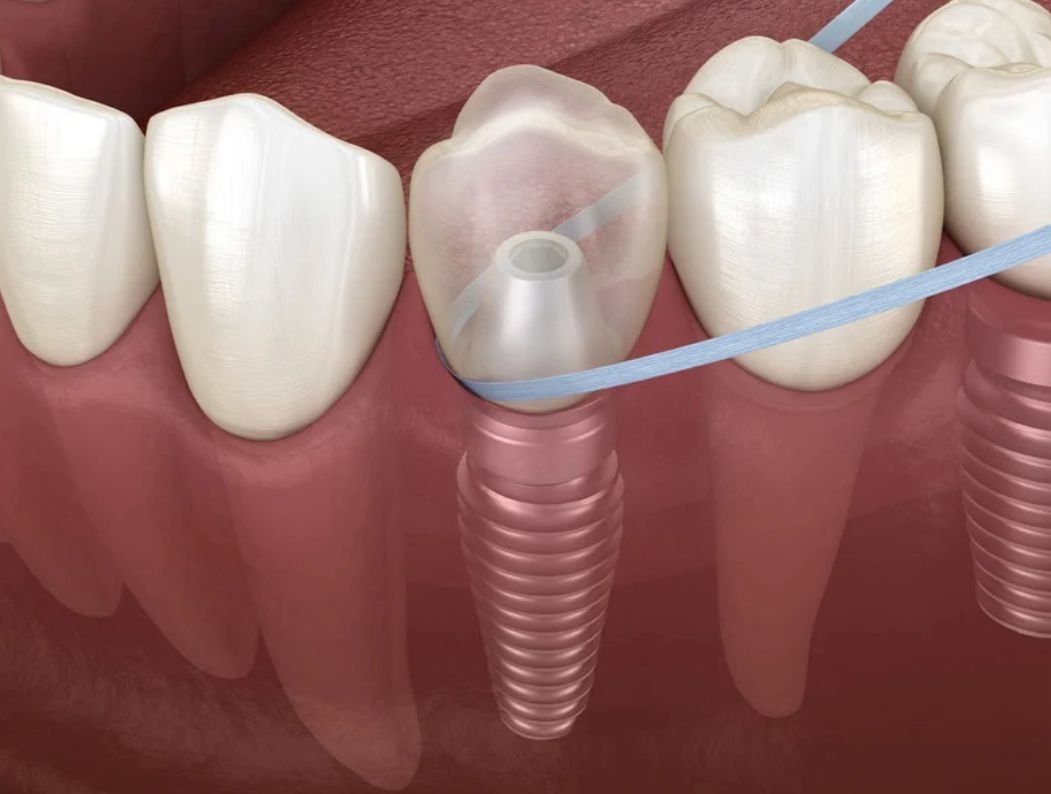 Implantes Dentales